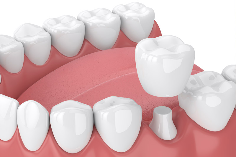 Dental Crowns in Berkeley