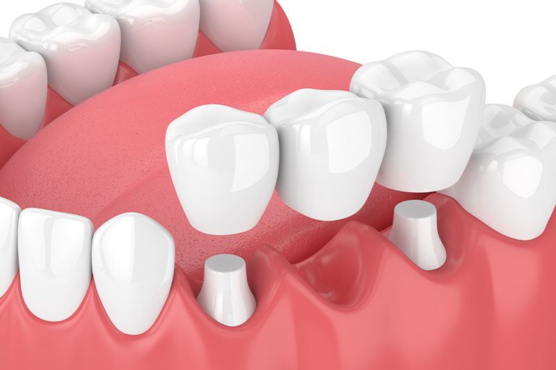 Dental Bridges in Berkeley