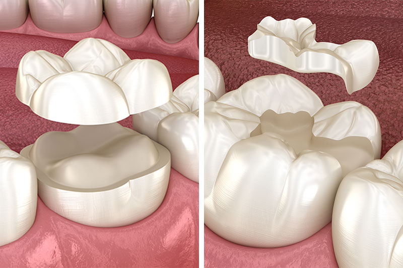 Dental Inlays and Onlays in Berkeley