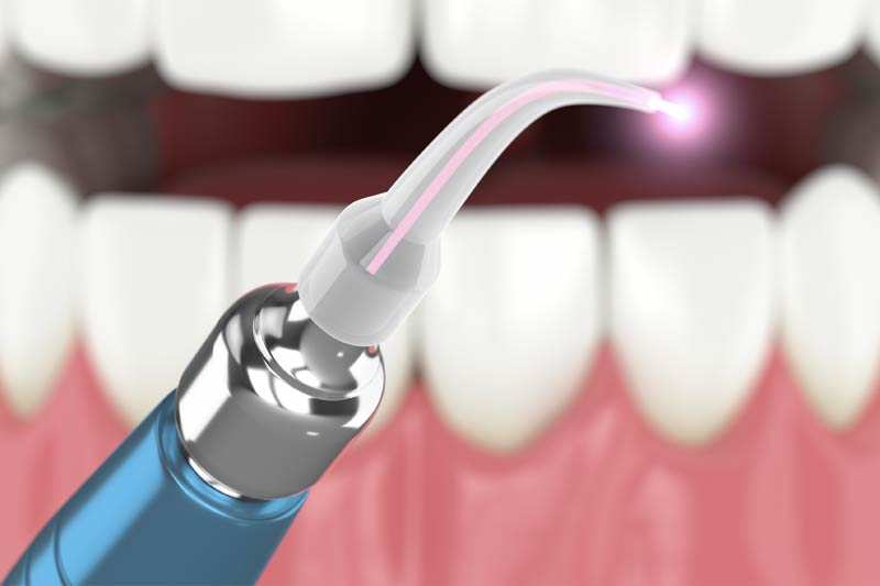 Laser Dentistry in Berkeley